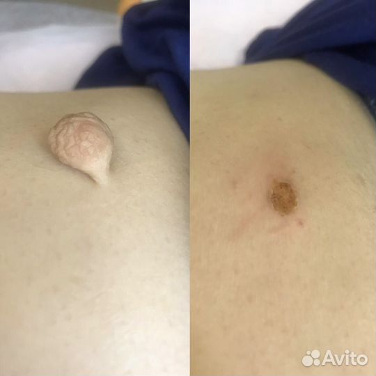 Удаление папилломы