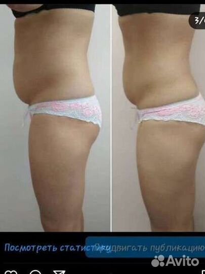 Аппаратная коррекция фигуры