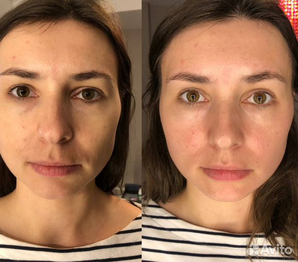 Сплит массаж лица/буккальный массаж косметолог