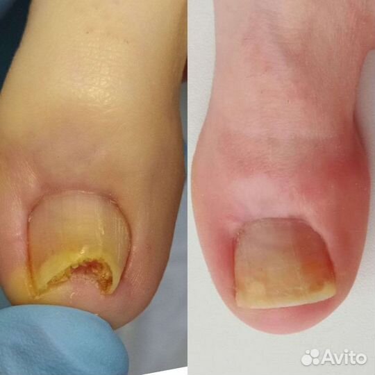 Медицинский, Смарт и Классический Педикюр/Подолог