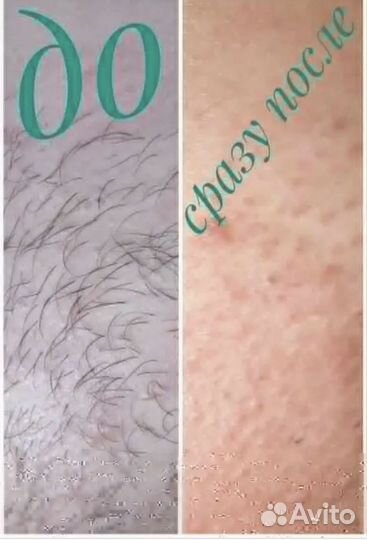 Мастер электроэпиляции