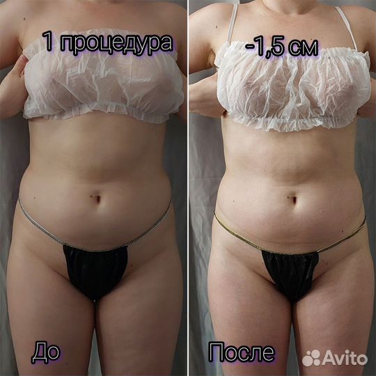 Карамельная липосакция, массаж, коррекция фигуры
