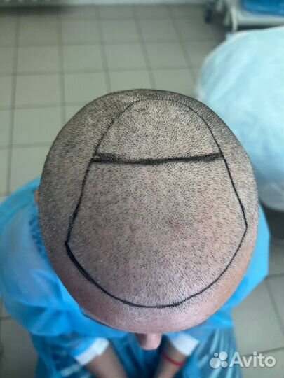 Пересадка волос за 1 день