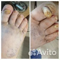 Педикюр для проблемных ног