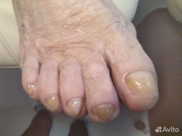 Медицинский педикюр подолог