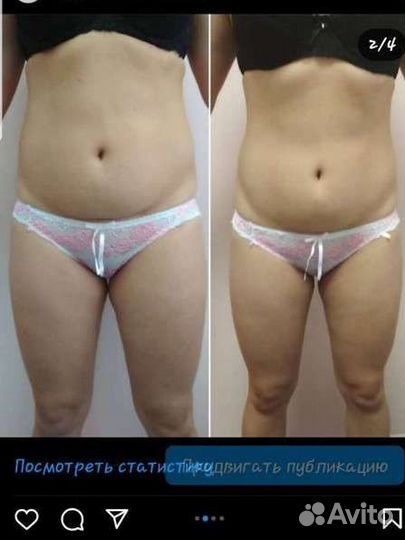 Аппаратная коррекция фигуры