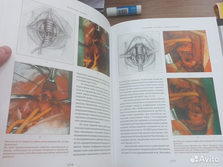 Хирургия трахеи с атласом оперативной хирургии