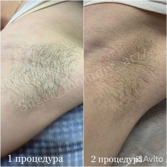 Электроэпиляция