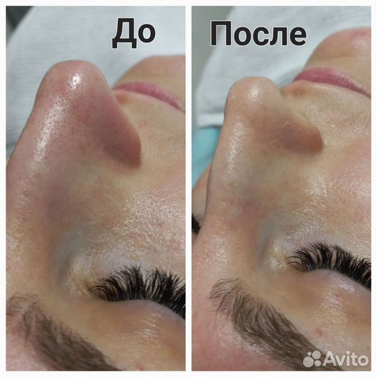 Чистка лица/RFлифтинг/Массаж лица/Пилинг