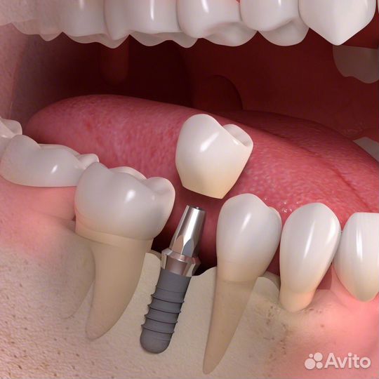 Импланты зубные