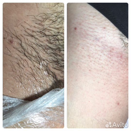 Электроэпиляция (женская/мужская). Игла включена