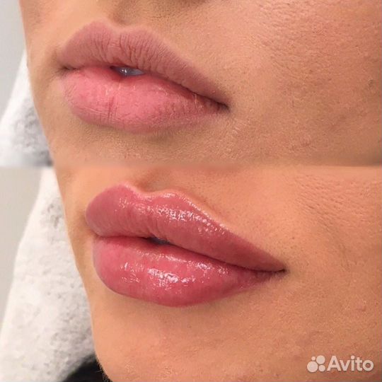 Врач - косметолог, ботокс, коллагенотерапия