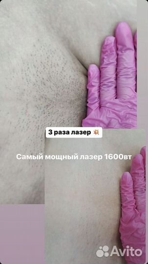 Лазерная эпиляция