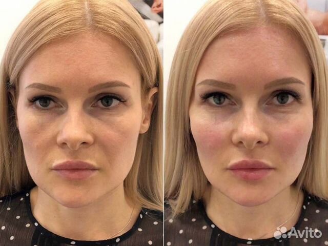Косметолог. Омоложение лица / чистка лица в Москве | Услуги | Авито
