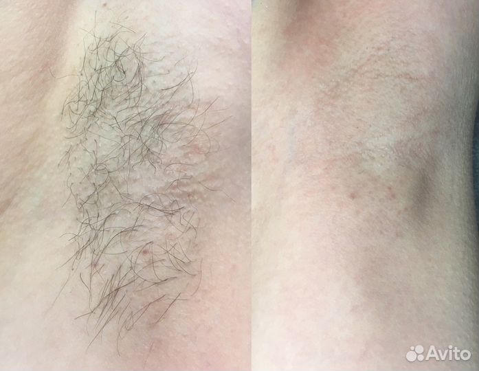 Шугаринг (Сахарная депиляция) женский, мужской