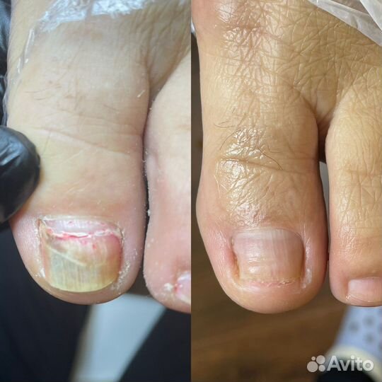 Лечебный педикюр