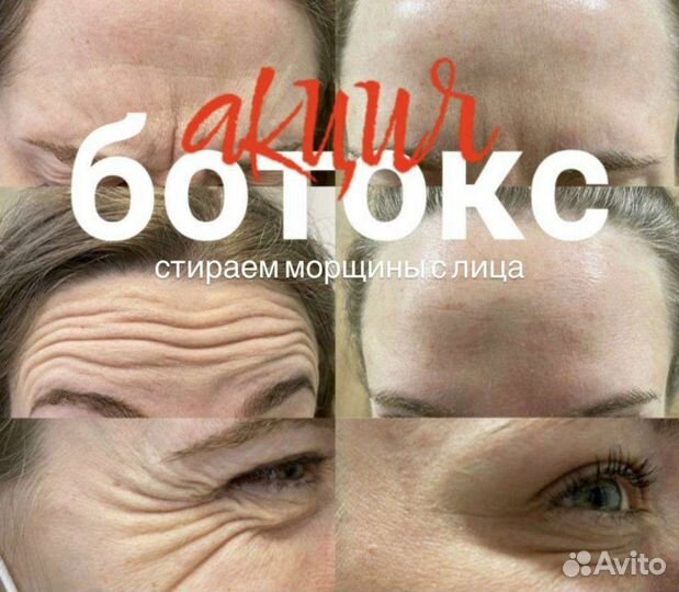 Контурная пластика