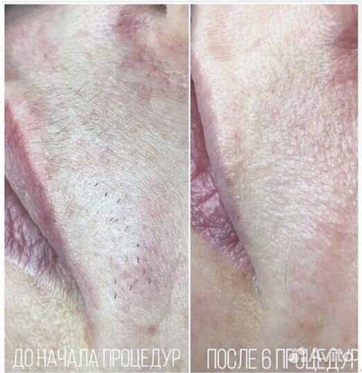 Мастер электроэпиляции