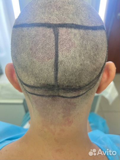 Пересадка волос за 1 день