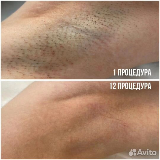 Лазерная эпиляция пилинг чистка лица косметолог