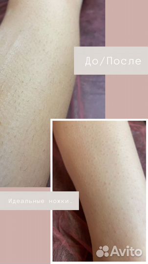 Депиляция