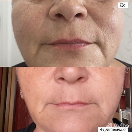 Смас лифтинг