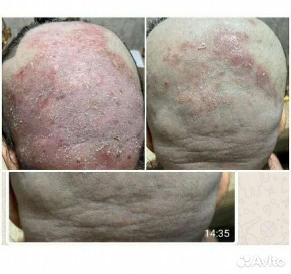 Мазь,крем,лишай, Псориаз, зуд