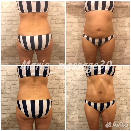 Антицеллюлитный массаж ручной