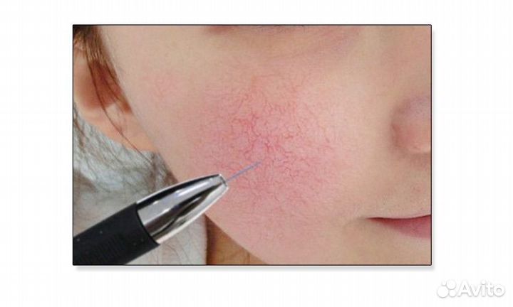 Аппарат для удаления сосудов