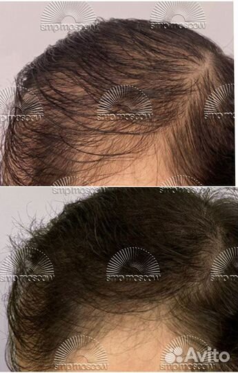 Имитация волос (фолликул), трихопигментация, smp