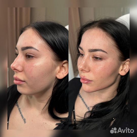 Безоперационная подтяжка лица