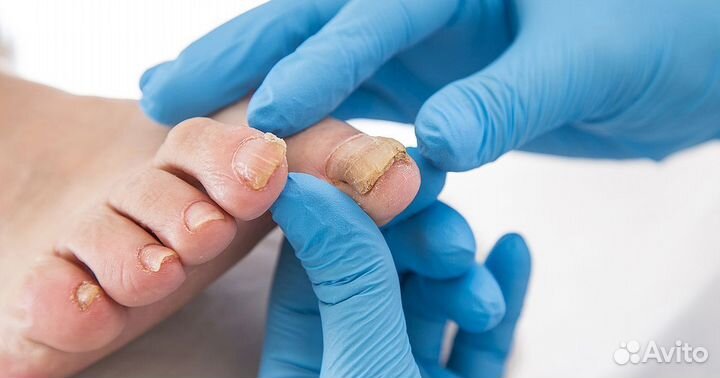 Медицинский педикюр подолог