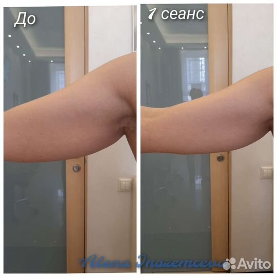 Коррекция фигуры/Кавитация/RF-лифтинг/ Вакуум +RF