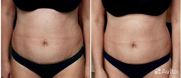 Вакумный массаж. Кавитация. Пресотерапия