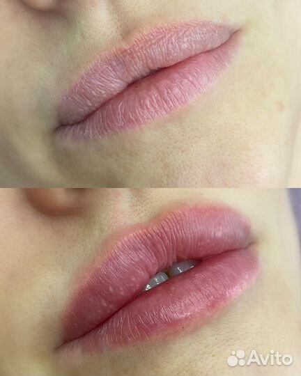 Врач косметолог/ Увеличение губ/ Ботокс