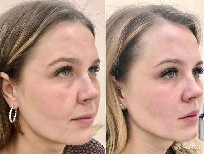 Смас лифтинг (smas лифтинг)