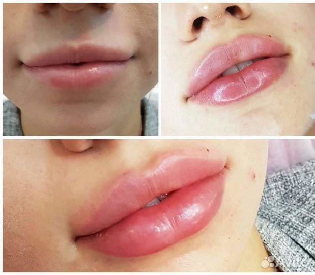 Ищу модель на контурную пластику губ