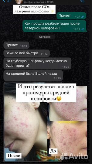 Лазерный аппарат Со2 Laser Fotona SpDynamis