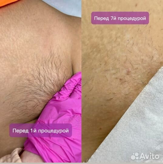Электроэпиляция