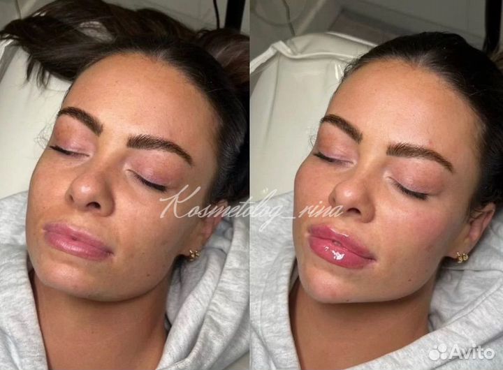 Контурная пластика,увеличение губ,ботокс