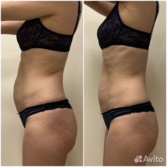 Липосоникс liposonix