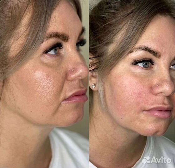 Смас лифтинг (smas лифтинг)