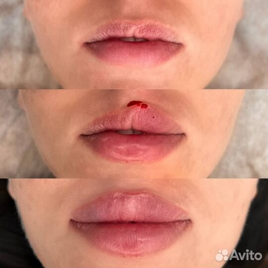 Контурная пластика губ