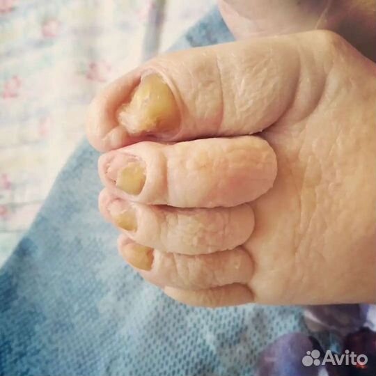 Педикюр(подолог)