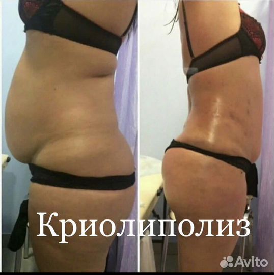 Криолиполиз New система липосакции