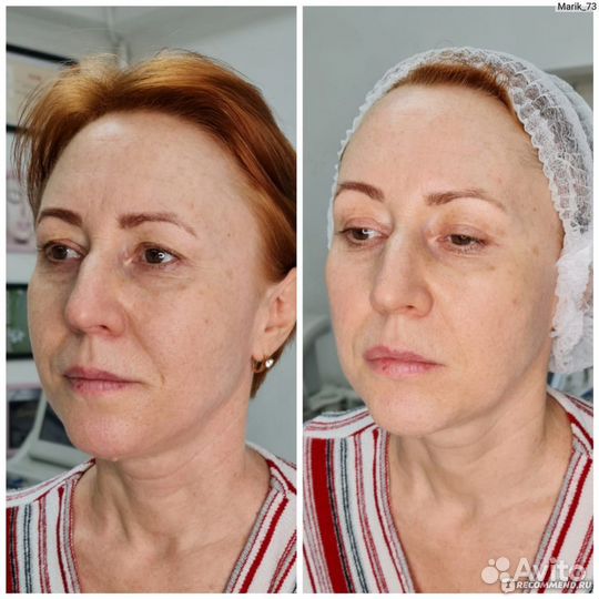 СМАС лифтинг