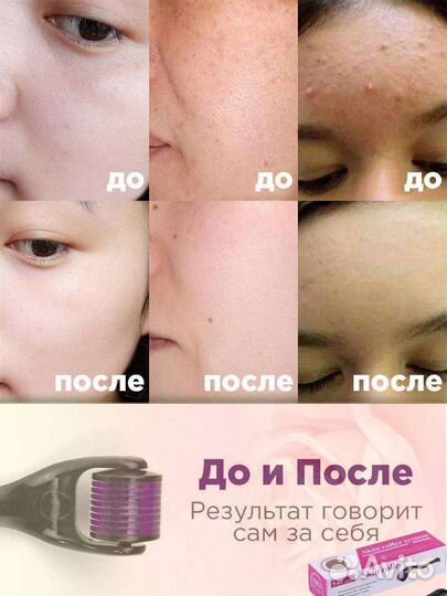 Мезороллер для лица