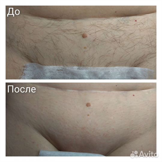 Шугаринг/Воск