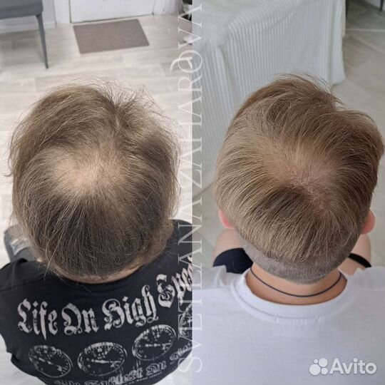 Трихопигментация