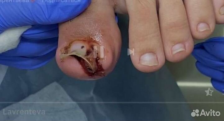 Сложный педикюр трещины вросший ноготь ищу модель